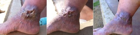 Varicose Vein Ulcers: after intensive treatment with the Basix Skin Repair Cream, the ankle is well on its way to recovery.